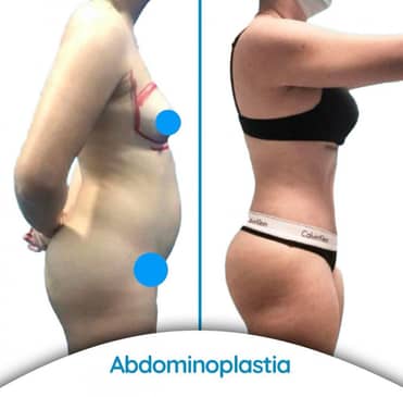 Slider image (7) Dr. Alvaro Uribe - Plastic Surgery in Colombia